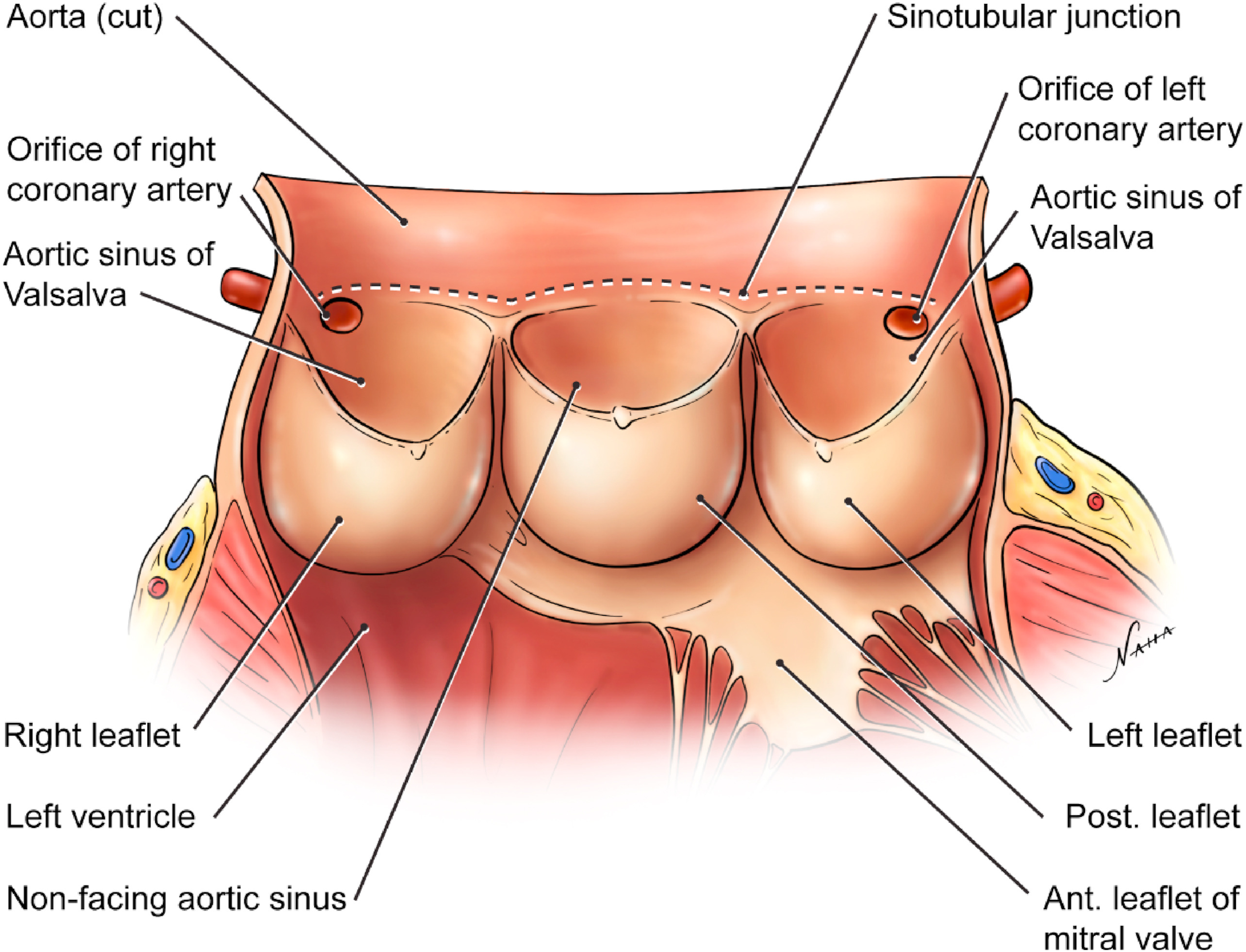 Nahabedian Drawing Aortic Valve Leaflets And Sinuses English Labels Anatomytool 3786